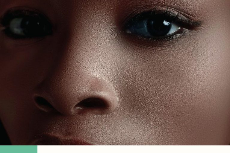 Acné sur peau noire : limiter les taches après les boutons