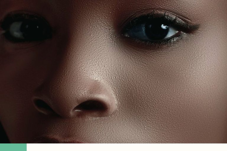 Mélasma sur peau noire : taches diffuses et facteurs déclenchants